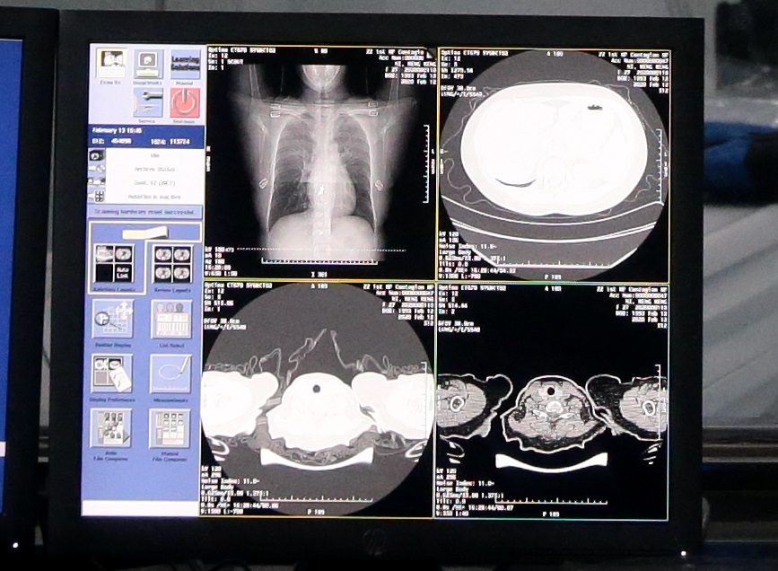 阿里巴巴達摩院及阿里雲合力研發AI診斷技術，自動識別肺炎病例的CT影像。