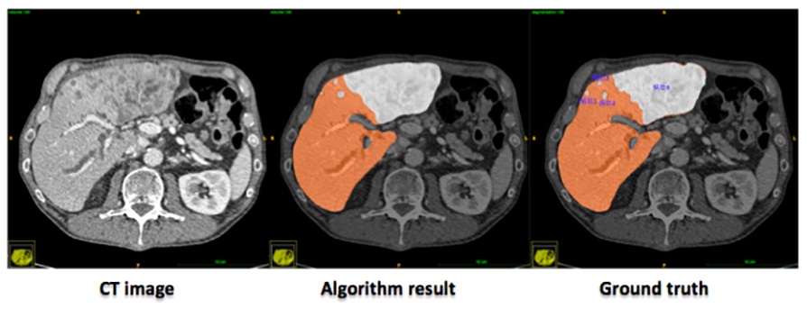 左圖為CT圖像，中間灰色部分是阿里巴巴AI識別的肝結節，右圖是臨床醫生的診斷，與阿里巴巴AI識別的結果一致。
